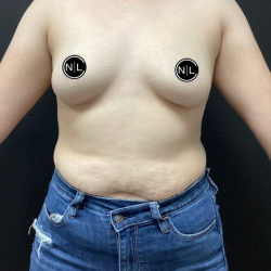 Breast Augmentation Before & After Patient #16154