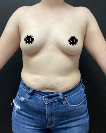 Breast Augmentation Before & After Patient #16154