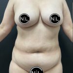 Mommy Makeover Before & After Patient #16262
