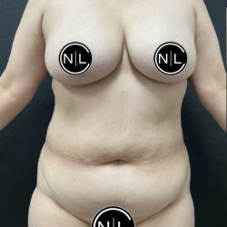 Mommy Makeover Before & After Patient #16262