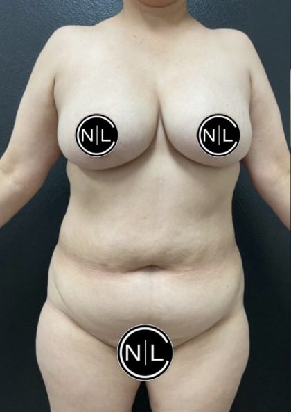 Mommy Makeover Before & After Patient #16262
