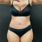 Abdominoplasty Before & After Patient #16153