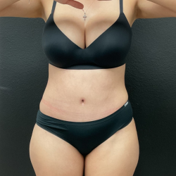 Abdominoplasty Before & After Patient #16153