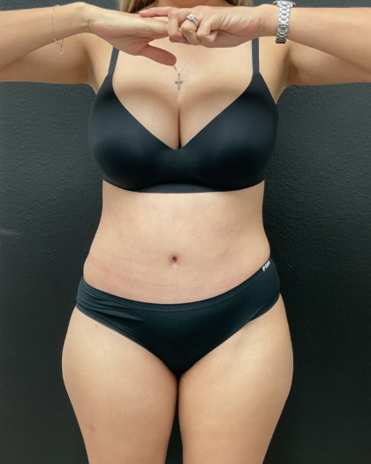Abdominoplasty Before & After Patient #16153
