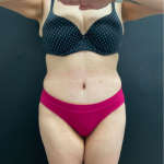 Tummy Tuck Before & After Patient #16260