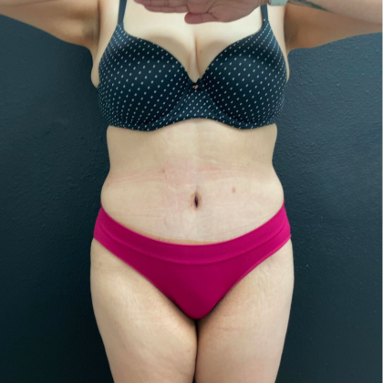 Tummy Tuck Before & After Patient #16260