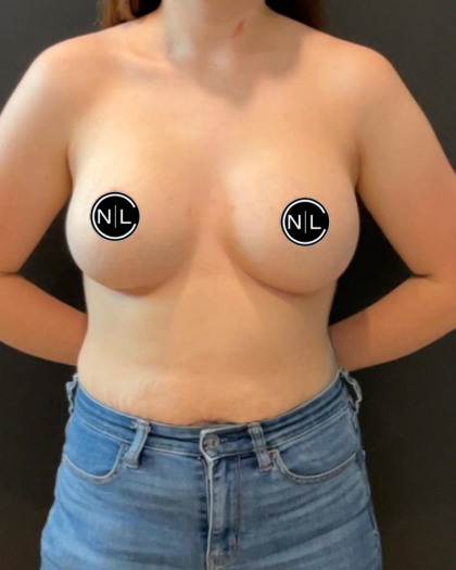 Breast Augmentation Before & After Patient #16154