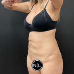 Abdominoplasty Before & After Patient #16153
