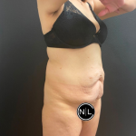 Tummy Tuck Before & After Patient #16260