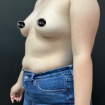 Breast Augmentation Before & After Patient #16154