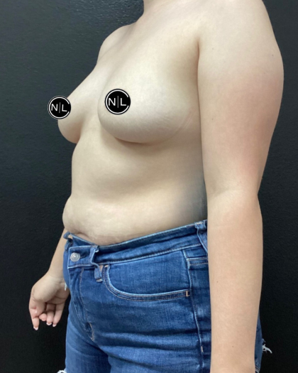 Breast Augmentation Before & After Patient #16154
