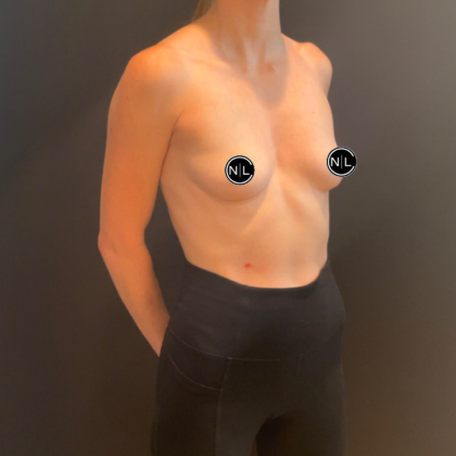 Breast Augmentation Before & After Patient #16259