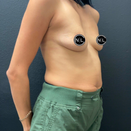 Breast Augmentation Before & After Patient #16261