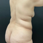 Mommy Makeover Before & After Patient #16262