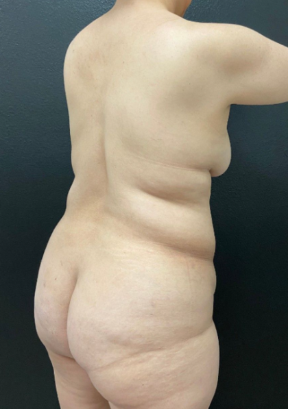 Mommy Makeover Before & After Patient #16262