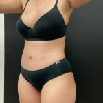 Abdominoplasty Before & After Patient #16153