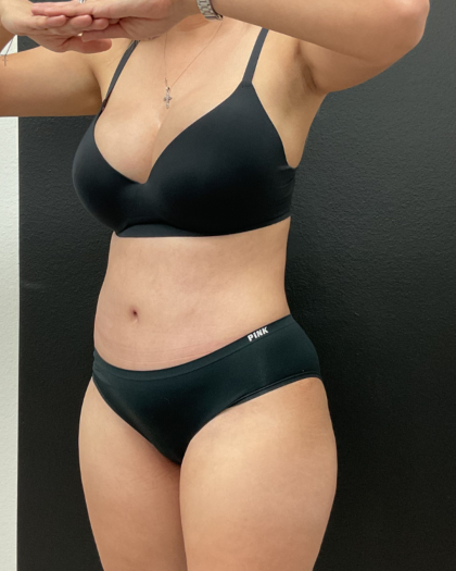 Abdominoplasty Before & After Patient #16153