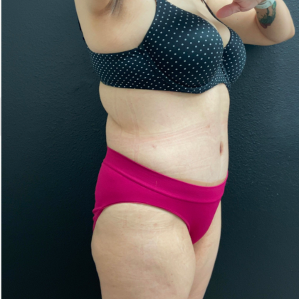Tummy Tuck Before & After Patient #16260