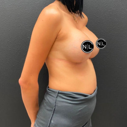 Breast Augmentation Before & After Patient #16261