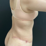 Mommy Makeover Before & After Patient #16262