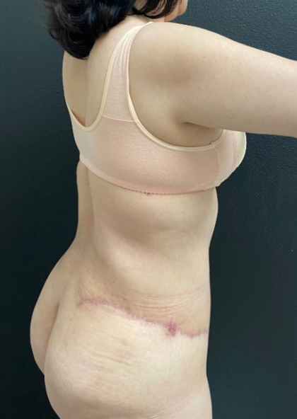Mommy Makeover Before & After Patient #16262