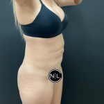 Abdominoplasty Before & After Patient #16153