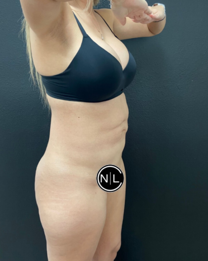 Abdominoplasty Before & After Patient #16153