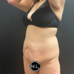 Tummy Tuck Before & After Patient #16260