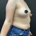 Breast Augmentation Before & After Patient #16154