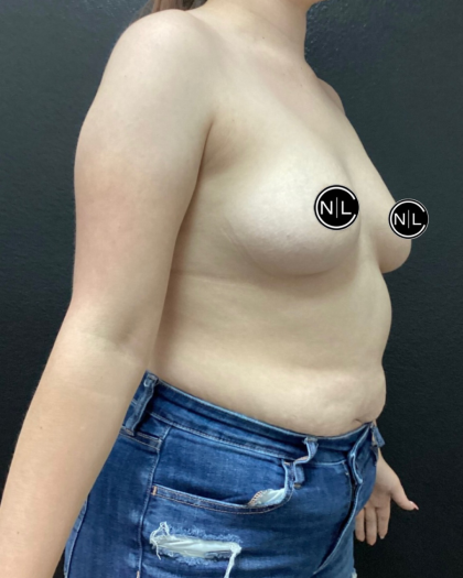 Breast Augmentation Before & After Patient #16154