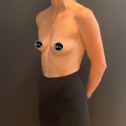 Breast Augmentation Before & After Patient #16259