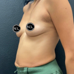 Breast Augmentation Before & After Patient #16261