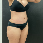 Abdominoplasty Before & After Patient #16153