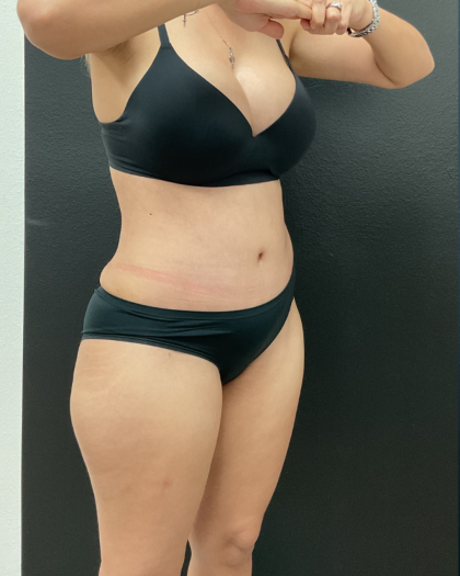Abdominoplasty Before & After Patient #16153