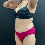 Tummy Tuck Before & After Patient #16260