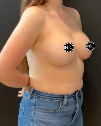 Breast Augmentation Before & After Patient #16154