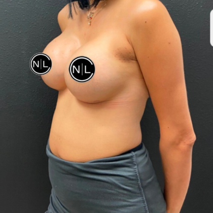 Breast Augmentation Before & After Patient #16261