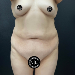 Abdominoplasty Before & After Patient #16332
