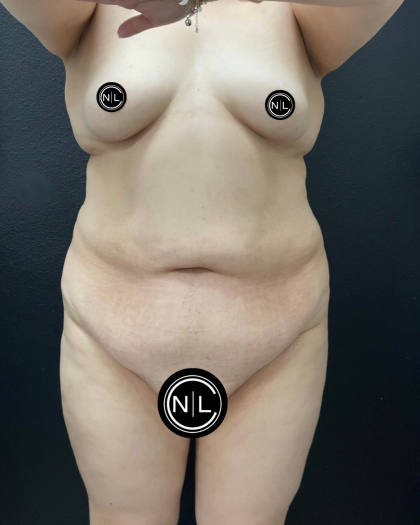 Abdominoplasty Before & After Patient #16332