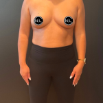 Breast Augmentation Before & After Patient #16310