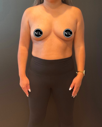 Breast Augmentation Before & After Patient #16310