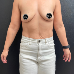 Breast Augmentation Before & After Patient #16309