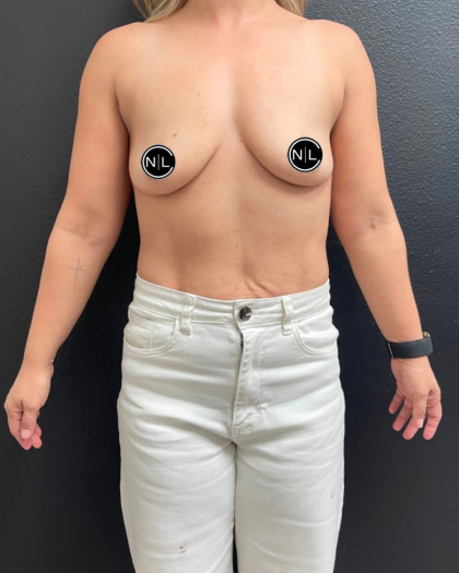 Breast Augmentation Before & After Patient #16309