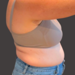Weight Loss Before & After Patient #16311