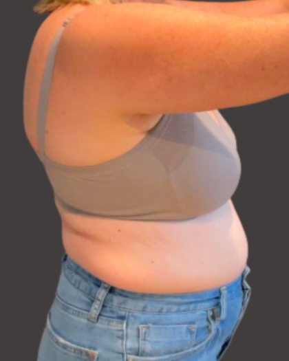 Weight Loss Before & After Patient #16311