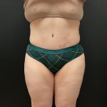 Abdominoplasty Before & After Patient #16332