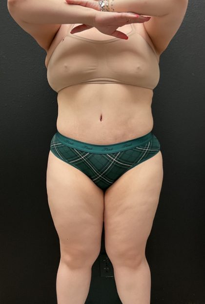 Abdominoplasty Before & After Patient #16332