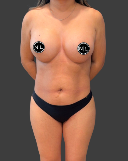Breast Augmentation Before & After Patient #16310