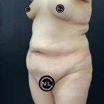 Abdominoplasty Before & After Patient #16332