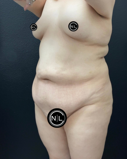 Abdominoplasty Before & After Patient #16332
